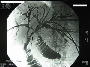 Tratamiento percutáneo de una obstrucción de asa aferente de hepaticoyeyunostomía por recidiva tumoral endoluminal. Flecha negra: zona estenótica tumoral. Flecha blanca: extremo proximal del asa de yeyunostomía, convertida en asa ciega.