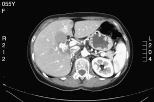 Imagen de tomografía donde se aprecia lesión polipoidea intravesicular hipervascular con lavado, de aproximadamente 2cm de diámetro, altamente sugestiva de proceso neoplásico.