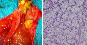 A. Fotografia de la pieza quirúrgica abierta donde se aprecia la tumoración intravesicular. B. Estudio anatomopatológico de la pieza donde se aprecian células tumorales redondas y con abundante citoplasma claro no papilar típico de los carcinomas de células claras.