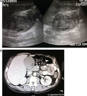 A) Ecografía abdominal. Vesícula con contenido sólido. B) TC de abdomen que muestra distensión vesicular.