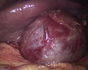 Hemocolecisto.