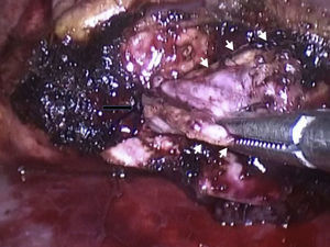 Fotografía intraoperatoria que evidencia la lesión den la cabeza del páncreas parcialmente disecada. Flechas blancas: márgenes de la lesión. Flecha negra: cuello de la lesión.