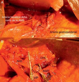1A) Disección de la arteria hepática derecha aberrante y de la arteria gastroduodenal. 1B) Anastomosis termino-terminal. Arteria hepática derecha aberrante (AHD), arteria gastroduodenal (AGD), vena porta (VP), conducto hepático común (CHC). La línea de puntos indica la anastomosis entre la AHD y la AGD.