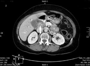 Angio TAC abdominal. La flecha señala la infiltración de la arteria hepática derecha por la tumoración de la cabeza del páncreas.