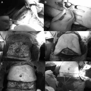 Imágenes intraoperatorias. A) Despegamiento de colgajo superior. B) Incisión periumbilical. C) Despegamiento del colgajo superior hasta el reborde costal, respetando el ombligo. D) Estimación del tejido a resecar. E) Resección de tejido sobrante. F) Sutura de neoombligo, colocación de drenajes espirativos y cierre por planos.