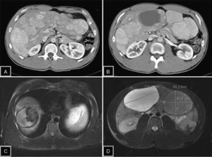 A) La tomografía computarizada (TC) de abdomen con contraste muestra la presencia de múltiples adenomas con realce en fase arterial, ocupando prácticamente todo el parénquima hepático. B) TC con lesión adenomatosa, heterogénea por sangrado intratumoral en segmento (S) IV. C) Resonancia magnética (RM) potenciada en T1 con saturación de la grasa, que evidencia lesión hiperintensa en S VIII por el componente hemorrágico intralesional. D) RM potenciada en T2 con saturación de la grasa: se identifican 2 lesiones, una en S V-VI, hiperintensa con componente quístico, y otra en S III isointensa, característica típica del adenoma hepático.