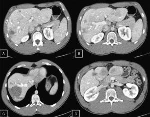 TC de control a los 3 años. A-D) Se aprecia disminución del número, tamaño de los adenomas hepáticos así como un cambio de su densidad. C) Disminución del tamaño y componente hemorrágico del adenoma del S VIII, sin signos de resangrado. D) Reabsorción parcial del componente quístico del S V.