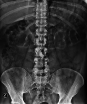 Radiografía simple de abdomen en decúbito. Se aprecia un patrón hidroaéreo intraluminal normal, una marcada delimitación de los psoas y del contorno del colon transverso.