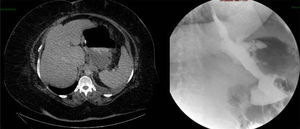 TAC abdominal (izquierda) donde se evidencia absceso intraabdominal secundario a fístula gástrica. Tránsito gastroduodenal (derecha) con fuga de contraste en tercio superior de la GVL.