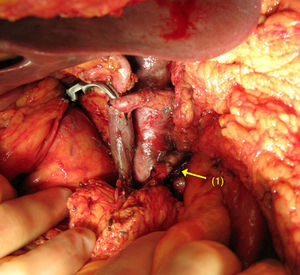 Duodenopancreatectomía cefálica con resección de arteria hepática común (1) y vena mesentérica superior (2).