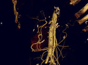 Comprobación radiológica postoperatoria de la «arterialización natural hepática» tras pancreatectomía corporocaudal (90%) extendida con resección en bloque de tronco celiaco. Revascularización a través de las arcadas pancreaticoduodenales y arteria gastroduodenal.