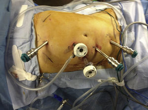 Disposición de trocares a nivel abdominal.