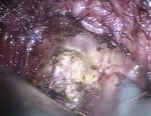 Disección de cara anterior por fascia de Denonvilliers.
