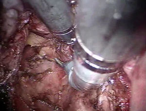 Disección de cara posterior por fascia mesorrectal.