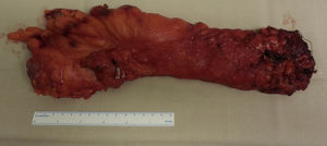 Espécimen quirúrgico con escisión total mesorrectal.