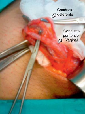 Imagen intraoperatoria donde se aprecia los elementos del cordón y el conducto peritoneo-vaginal.