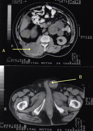 A) Liposarcoma en región dorso-lumbar derecha. B) Liposarcoma en cordón espermático izquierdo.