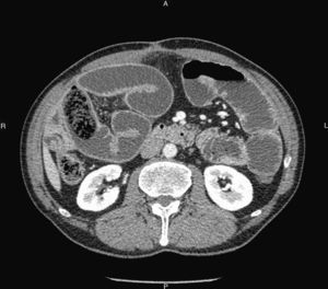 TC abdominal. Oclusión intestinal por voluminoso bezoar impactado en ileon distal; importante distensión de asas de intestino delgado.