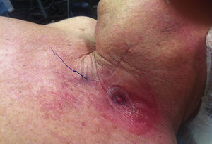 Esofagostomía y sutura de Prolene® que referencia el polo superior del tubo gástrico.