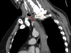 Tomografía computarizada de tórax que muestra la distancia entre el extremo proximal del tubo gástrico y la esofagostomía.