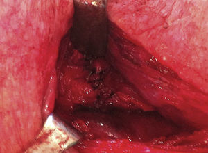 Imagen intraoperatoria de la anastomosis esofagogástrica.