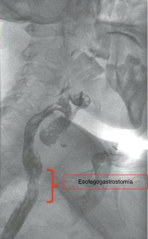 Fluoroscopia que muestra la anastomosis esofagogástrica y un correcto paso del contraste.