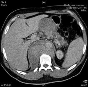 CT que muestra la rotura a nivel de la aorta toracica descendente.