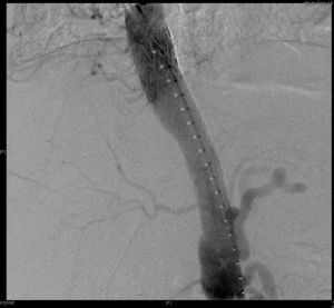 Imagen arteriográfica donde se observa la endoprótesis en aorta.
