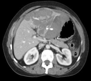 TAC coronal: lesión hepática.