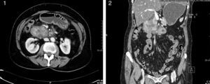 TAC abdominal evidenciando masa alrededor del duodeno con lesiones quísticas y estrechamiento de la luz duodenal.