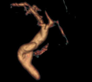 Imagen de colangiorresonancia magnética nuclear (reconstrucción tridimensional) donde se aprecia muñón cístico alargado.