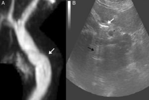 A) Imagen de colangiorresonancia magnética nuclear sin apreciarse claras imágenes de litiasis en el interior del muñón cístico. B) Imagen de ecografía abdominal donde se aprecia el colédoco (*) adyacente al muñón cístico alargado, con imágenes hiperecogénicas en su interior (flecha blanca) que dejan sombra acústica posterior (flecha negra) no artefactada, sugestiva de litiasis en su interior.
