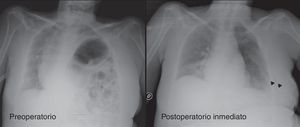 Se muestra la radiografía postero-anterior de tórax correspondiente al preoperatorio y postoperatorio inmediato de una plicatura diafragmática (paciente de 60 años con antecedentes de poliomielitis, tetraparesia y eventración diafragmática izquierda sintomática). Observe el desplazamiento del mediastino y la compresión de ambos pulmones y el hemidiafragma opuesto debido a la eventración del hemidiafragma izquierdo. Las puntas de flecha señalan el drenaje pleural postoperatorio.