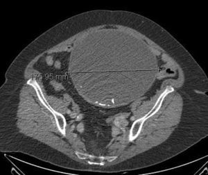 Imagen de TC donde apreciamos la lesión quística que ocupa buena parte del contenido abdominal e imágenes calcificadas en su interior.