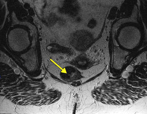 Melanoma anorrectal. Imagen de RM.