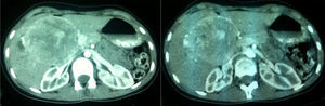TAC abdominal: gran tumor en hilio hepático.