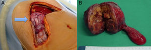 Pieza quirúrgica: tumor carcinoide de la vía biliar.