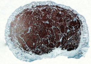 Tumor neuroendocrino rectal tratado mediante polipectomía endoscópica con borde de resección libre. Foto macro-micro. Inmunohistoquímica para sinaptofisina.