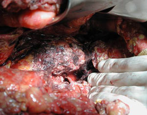 Necrosectomía de cuerpo y cola de páncreas a las 4 semanas desde el inicio del cuadro.