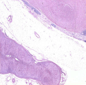 Corte histológico de la pieza donde se distingue el schwanoma de la glándula adrenal (Hematoxilina-eosina×10).
