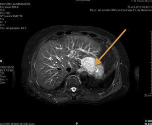 Imágenes de resonancia magnética con gadolinio que muestran la lesión hepática en segmento ii. 1.