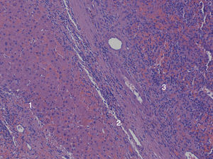 Muestra fijada en formol. (HES x100). 1) Tejido hepático (hepatitis crónica activa). 2) Cápsula fibrosa (1mm). 3) Pulpa roja esplénica (poco desarrollo de pulpa blanca).