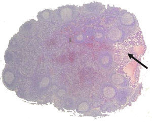 Micrometástasis localizada en un ganglio centinela.