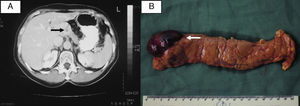 A) Imagen tomográfica mostrando formación quística con realce periférico localizada en el cuerpo del páncreas (flecha). B) Producto de pancreatectomía distal con formación quística (flecha).