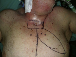 Imagen preoperatoria del paciente donde se observa la úlcera cutánea, la celulitis cervical y el diseño del colgajo a utilizar.