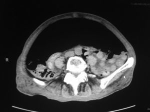 TAC abdominopélvica con abundante neumoperitoneo y desplazamiento de vísceras en sentido posterocaudal.
