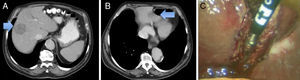 TAC. A. Metástasis en el hígado derecho. B. Metástasis en el sector lateral izquierdo. C. Resección laparoscópica.