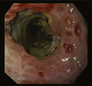 Atrapamiento del stent.