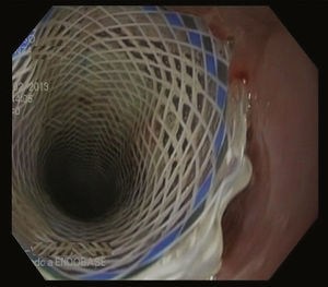 Liberación de ambas prótesis.