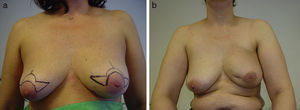 Deformidad tras hematoma en una mamoplastia horizontal. Un hematoma en la rama medial del patrón izquierdo ha originado una retracción local tras la irradiación mamaria.